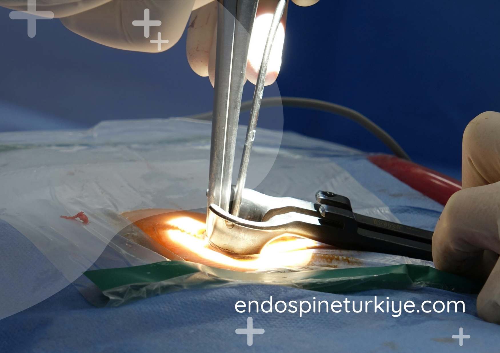 Omurga dar kanal tedavisi - Spinal kanal daralması ameliyatı