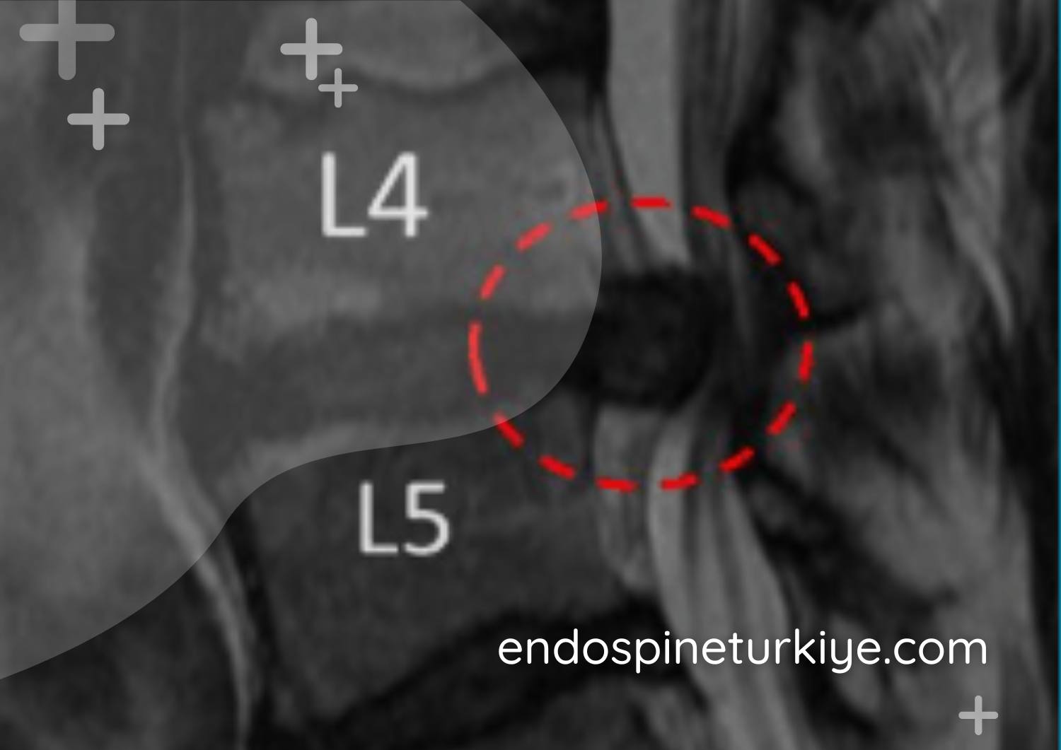 Omurga kanal daralması MR görüntüsü - Spinal stenoz teşhisi