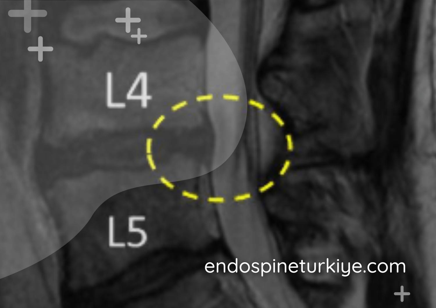 Kanal daralması ameliyatı sonrası - Genişletilmiş omurga kanalı