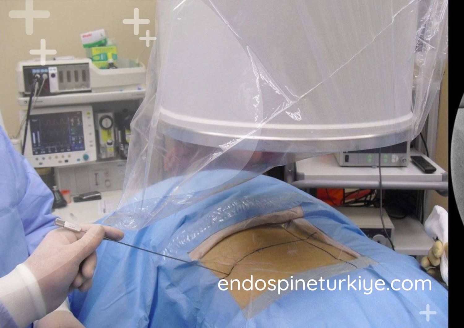 Endoskopik görüntüleme sistemi - HD kamera teknolojisi