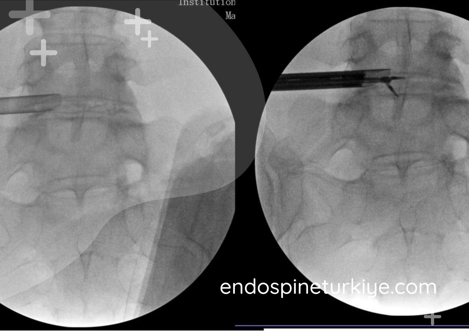 6mm minimal kesi - Kapalı yöntemle fıtık ameliyatı