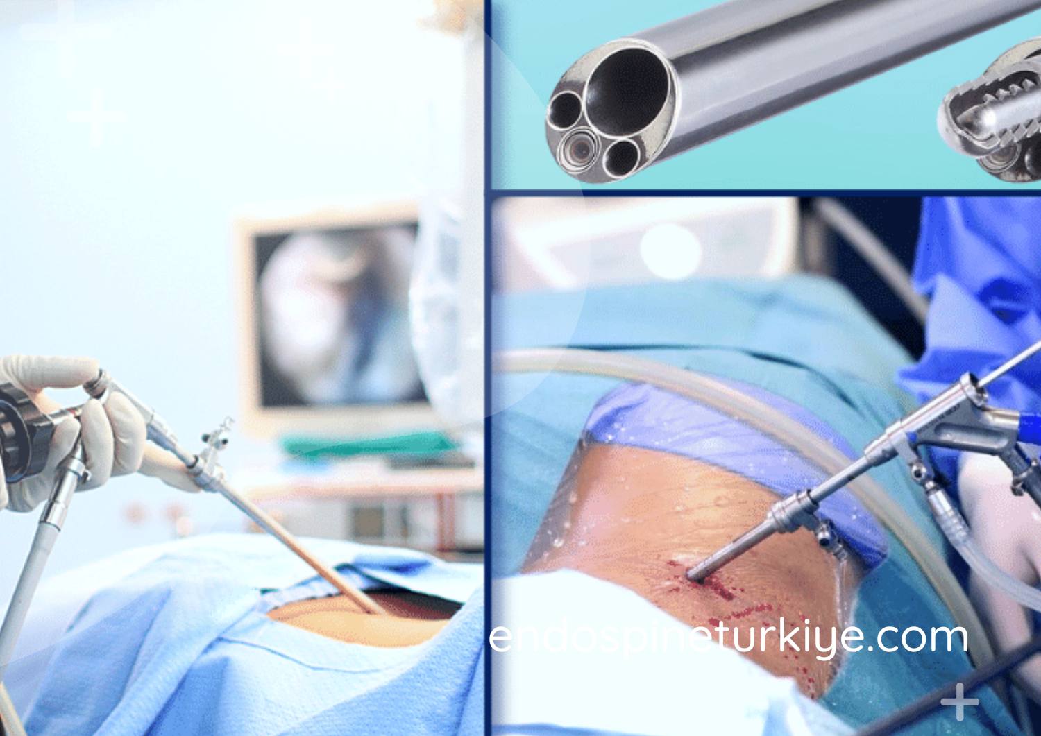 Tam kapalı endoskopik bel fıtığı ameliyatı görüntüsü - 6mm kesi ile minimal invaziv cerrahi işlem, HD endoskop kullanımı